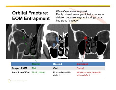 Imaging of Facial Trauma