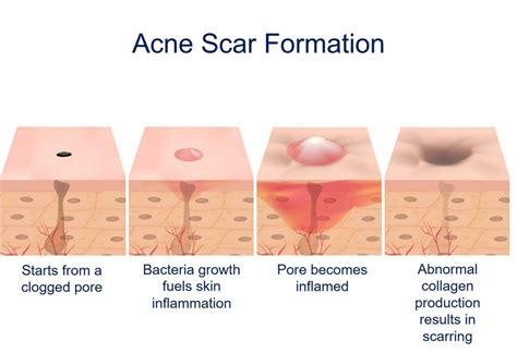 Comprehensive Acne Scars Treatment Guide - Aloybeauty