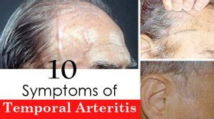 10 Symptoms of Temporal Arteritis - Getinfopedia.com