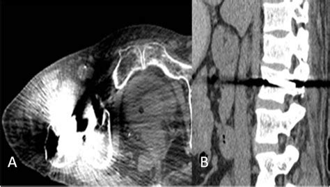 Beam Hardening Artifact Ct Radiology - The Best Picture Of Beam