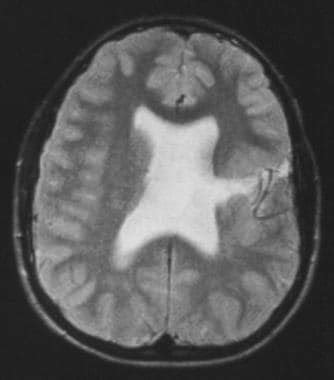 Schizencephaly Imaging: Practice Essentials, Computed Tomography ...