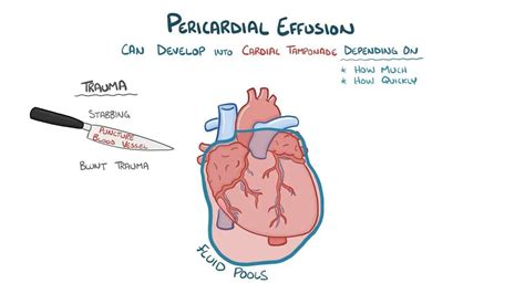 Pericardial Tamponade What Is It Causes Pericardial Effusion Signs | Porn Sex Picture