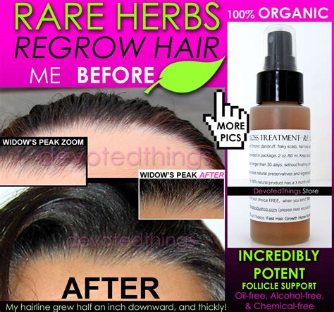 BEST ORGANIC Hair Regrowth Treatment Hair Loss Thinning Dandruff All In 1