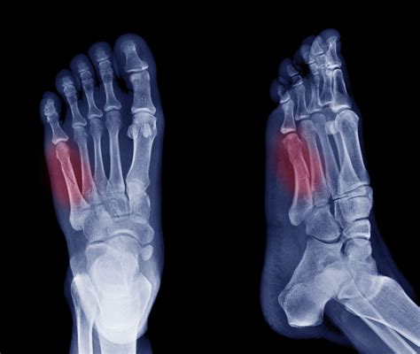 Xray Of Foot Stress Fracture