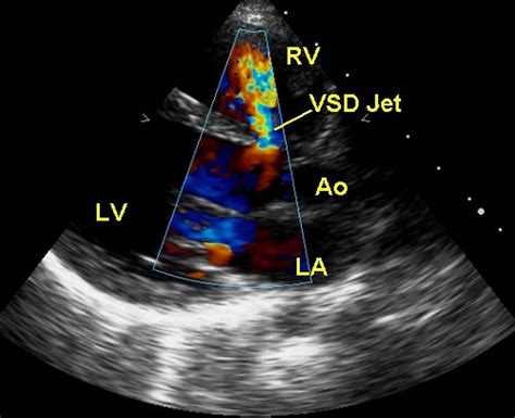 What is a perimembranous VSD? – All About Heart And Blood Vessels