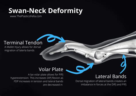 Swan Neck Deformity vs Boutonnières