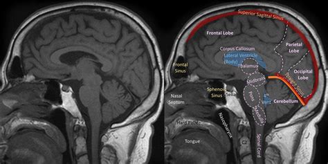 Sagittal MRI brain (T1) Diagram | Quizlet