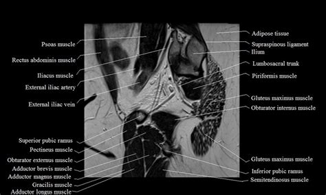 Uterus Anatomy Mri