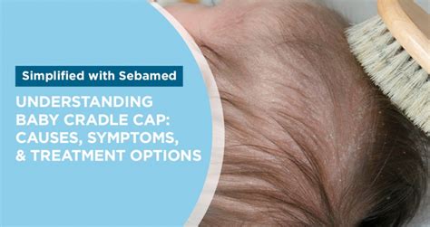 Understanding Cradle Cap: Causes, Symptoms & Treatment