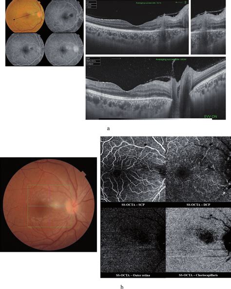 (A) Top left: Color fundus photo and FFA of the right eye of a... | Download Scientific Diagram