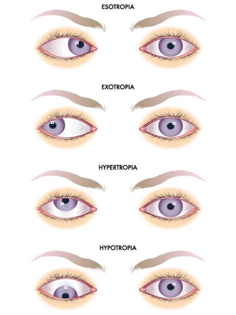 Types of Strabismus | Eye anatomy, Optometry education, Optometry school