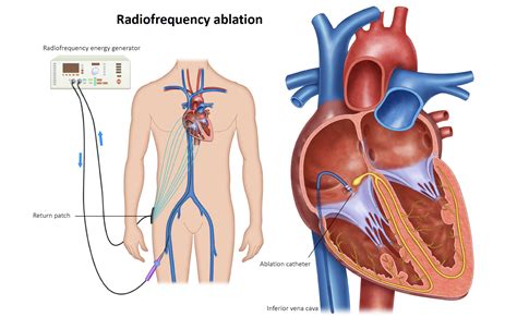 SVT Ablation - Melbourne Heart Group