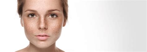 Common Skin Pigmentation Types | Cosmetic Medicine Centre