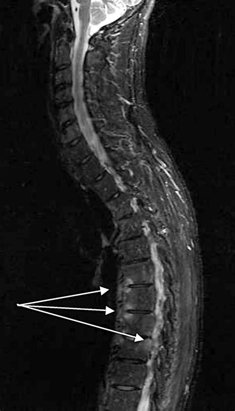 Inflammation in ankylosing spondylitis: a systematic description of the extent and frequency of ...