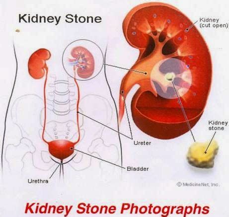 Urinary calculi (kidney and bladder), Definition, Risks, Causes, Symptoms and signs, infection ...