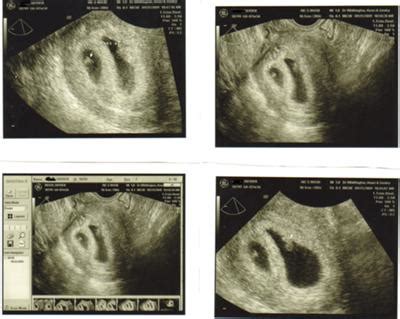 Twins at 6 Weeks: What's Like in Ultrasound Pictures? - New Kids Center