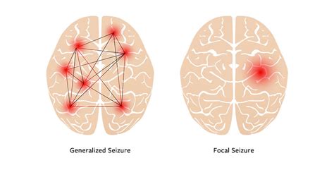 Understanding Different Kinds of Seizures – A2Z Facts