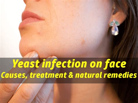 Yeast infection on face: Causes, treatment & natural home remedies