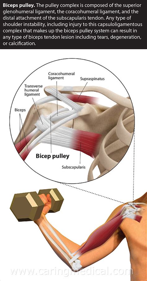 Biceps tendon tear treatment