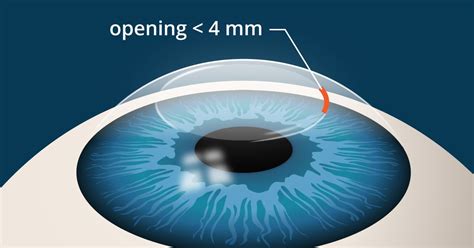 SMILE Eye Surgery: What's Different Than LASIK?