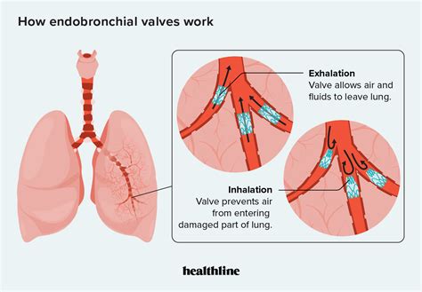 Zephyr Valve for COPD: Purpose, Benefits, Risks, and Procedure