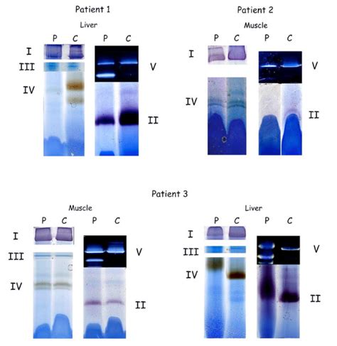 Blue native PAGE of the OXPHOS complexes. In-gel activity staining. In ...