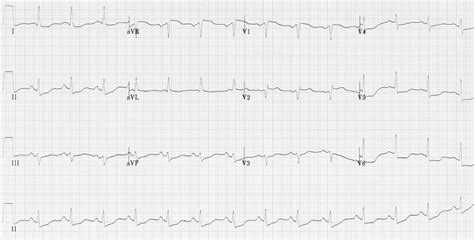 Myocardial Ischemia Ecg