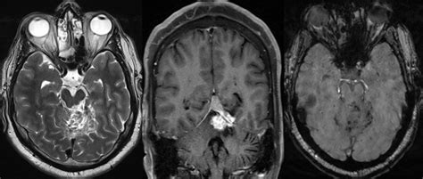 Post Radiotherapy Haemorrhage. Left tentorial meningioma. Post gamma... | Download Scientific ...