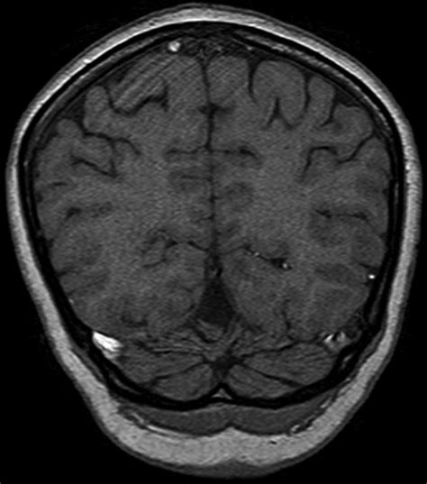 Transverse Sinus Mri