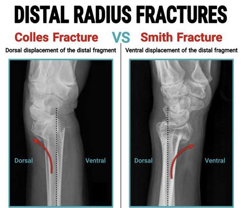 Smith Fracture X Ray