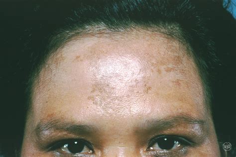 What's the Difference Between Melasma, Sun Spots, and Other Skin Spots ...