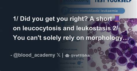 1/ Did you get you right? A short 🧵on leucocytosis and leukostasis ...