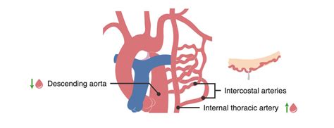 Coarctation Of Aorta Turner Syndrome - Captions Hunter