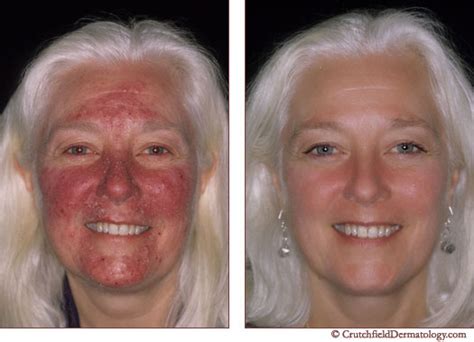 Before & After Acne Rosacea Treatment – Crutchfield Dermatology