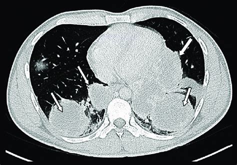 CT scan of the chest shows multiple large bilateral lung masses as seen... | Download Scientific ...