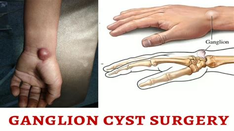 Ganglion Cyst