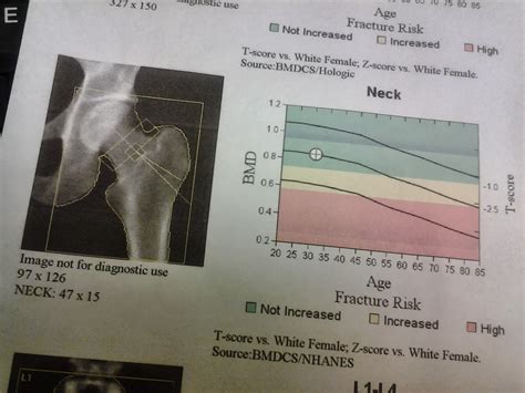 How I complicated my life today: DEXA scan bone density test