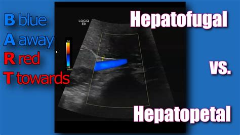 Ultrasound Hepatopetal Flow