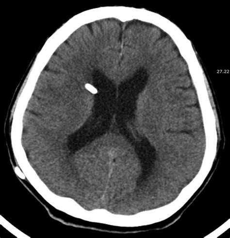 Computed tomography 30 days after ventriculoperitoneal shunt placement ...