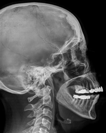 Hyperostosis frontalis interna | Radiology Case | Radiopaedia.org