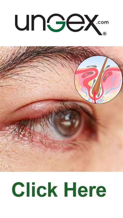 Ocular Rosacea: Causes, Symptoms, and Relief | Ocular rosacea, Skin ...