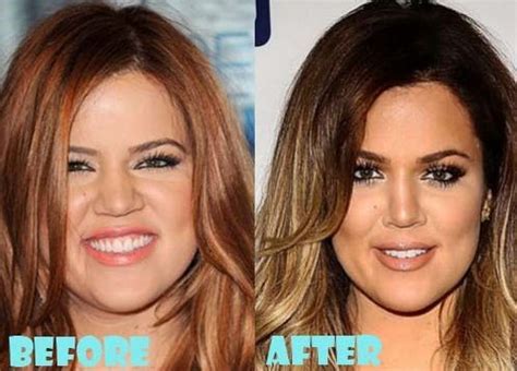 Khloe Kardashian before and after plastic surgery 08 – Celebrity ...