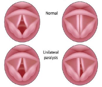 Treatment Options for Vocal Fold Paralysis - ENTtoday