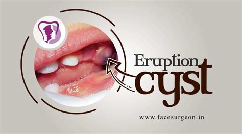 Eruption cyst – Richardson's Plastic Surgery Hospitals