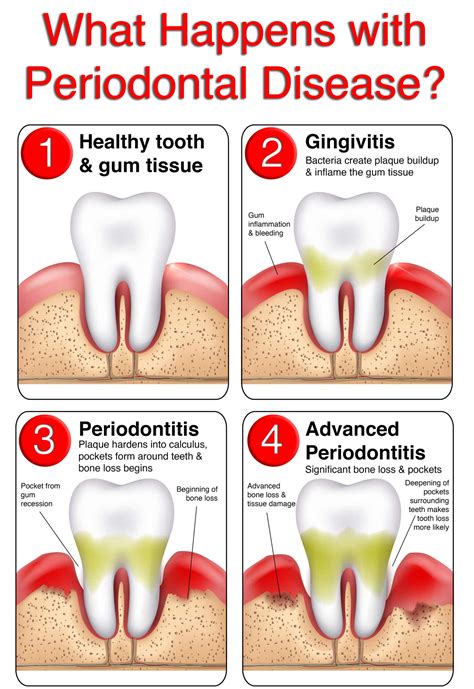 Gum Disease Early Signs