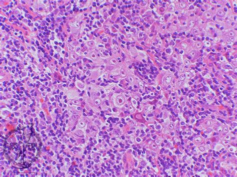 Nasopharyngeal Carcinoma Histology