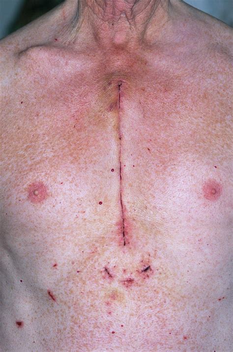 Coronary Bypass Chest Scar Photograph by Dr P. Marazzi/science Photo Library