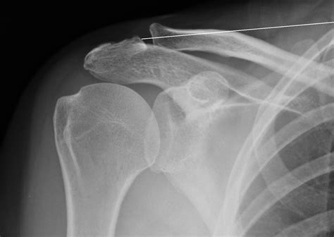 Acromioclavicular Ac Joint Arthritis