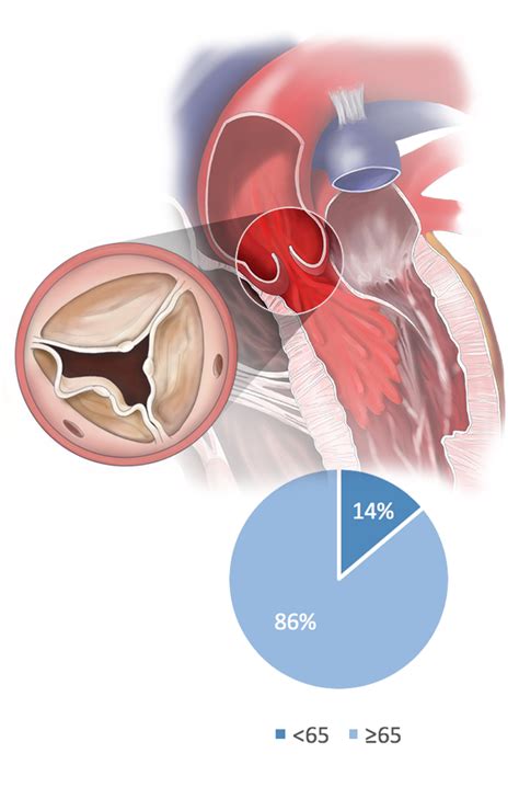 Aortic Valve Disease – BioStable Science & Engineering