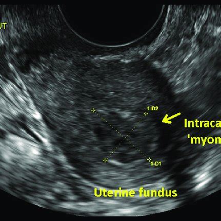 Transvaginal ultrasound, longitudinal view. No endometrial stripe is... | Download Scientific ...
